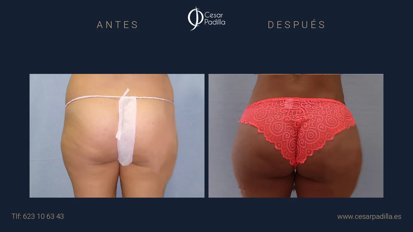 Antes y después de aumento de glúteos, caso 1