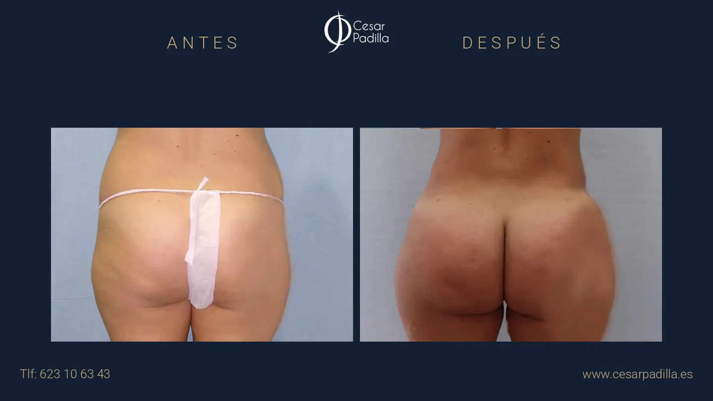 Antes y después de aumento de glúteos, caso 10