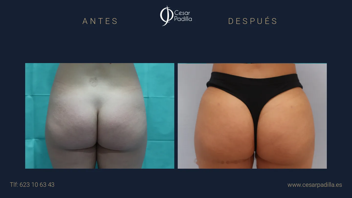 Antes y después de aumento de glúteos, caso 2