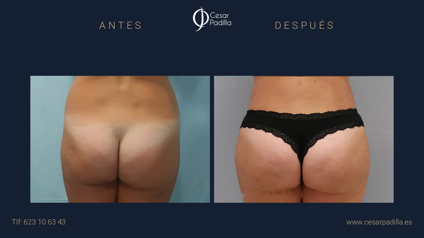 Antes y después de aumento de glúteos, caso 3