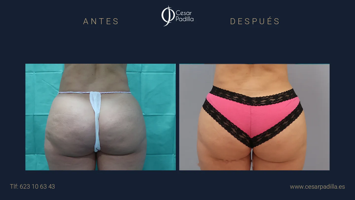 Antes y después de aumento de glúteos, caso 4