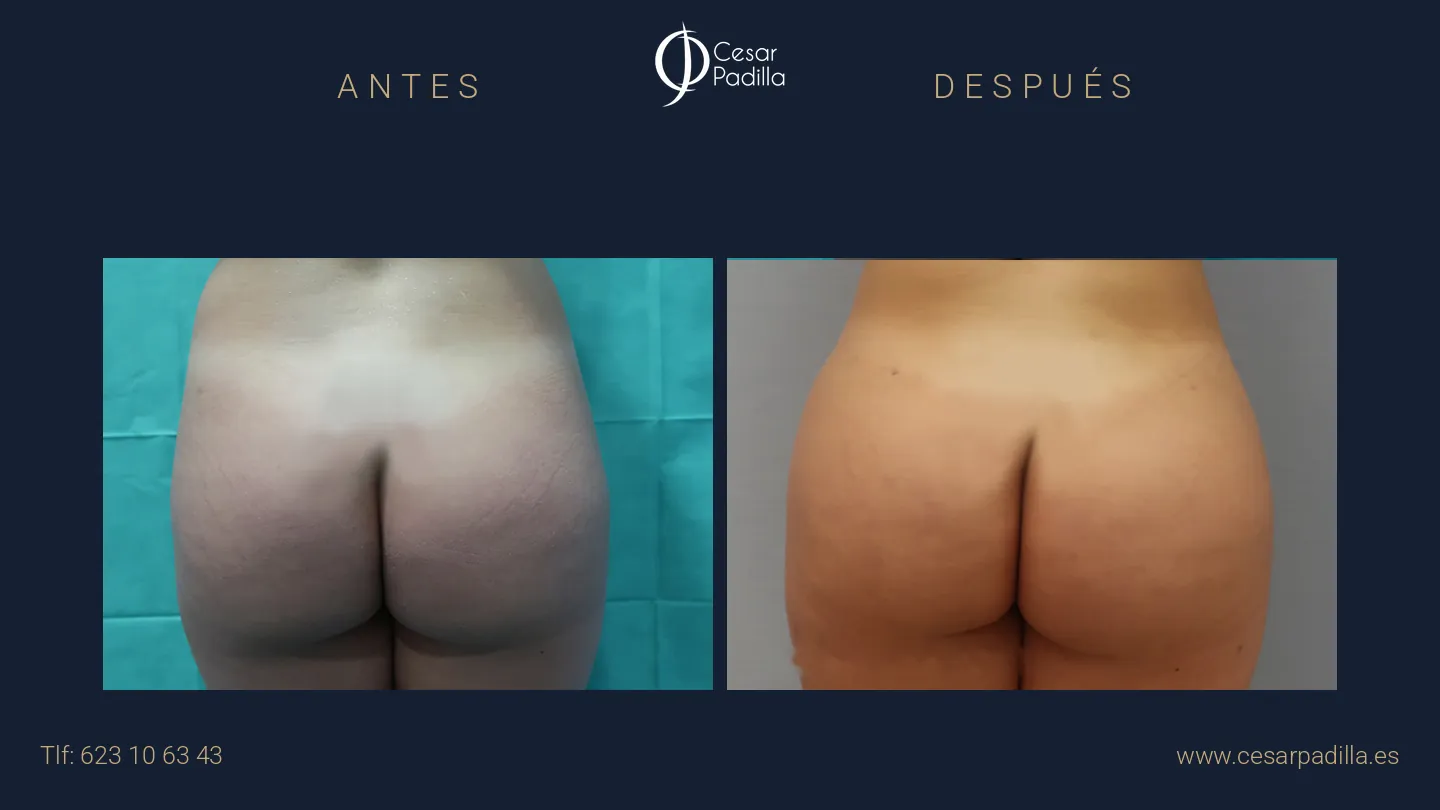 Antes y después de aumento de glúteos, caso 5