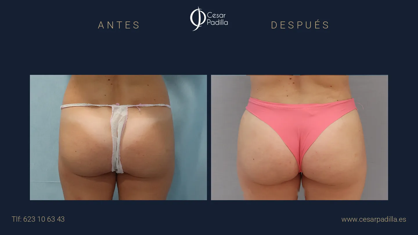 Antes y después de aumento de glúteos, caso 6