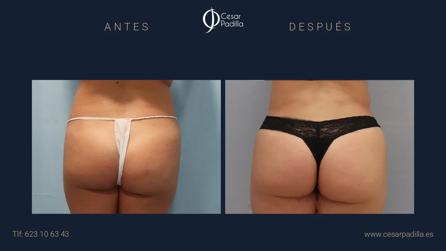 Antes y después de aumento de glúteos, caso 7