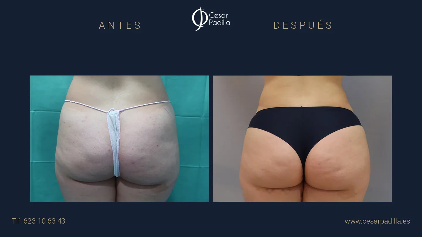 Antes y después de aumento de glúteos, caso 8