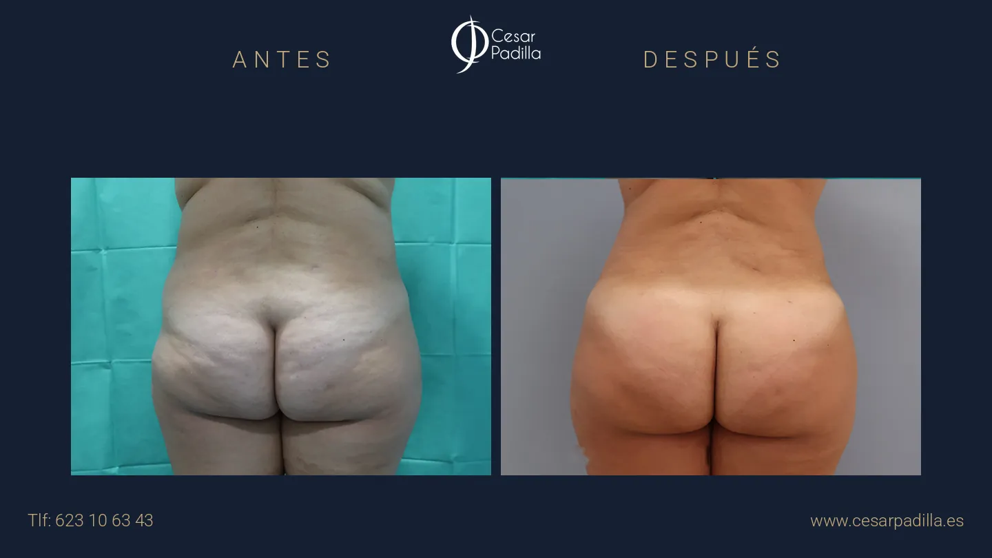 Antes y después de aumento de glúteos, caso 9