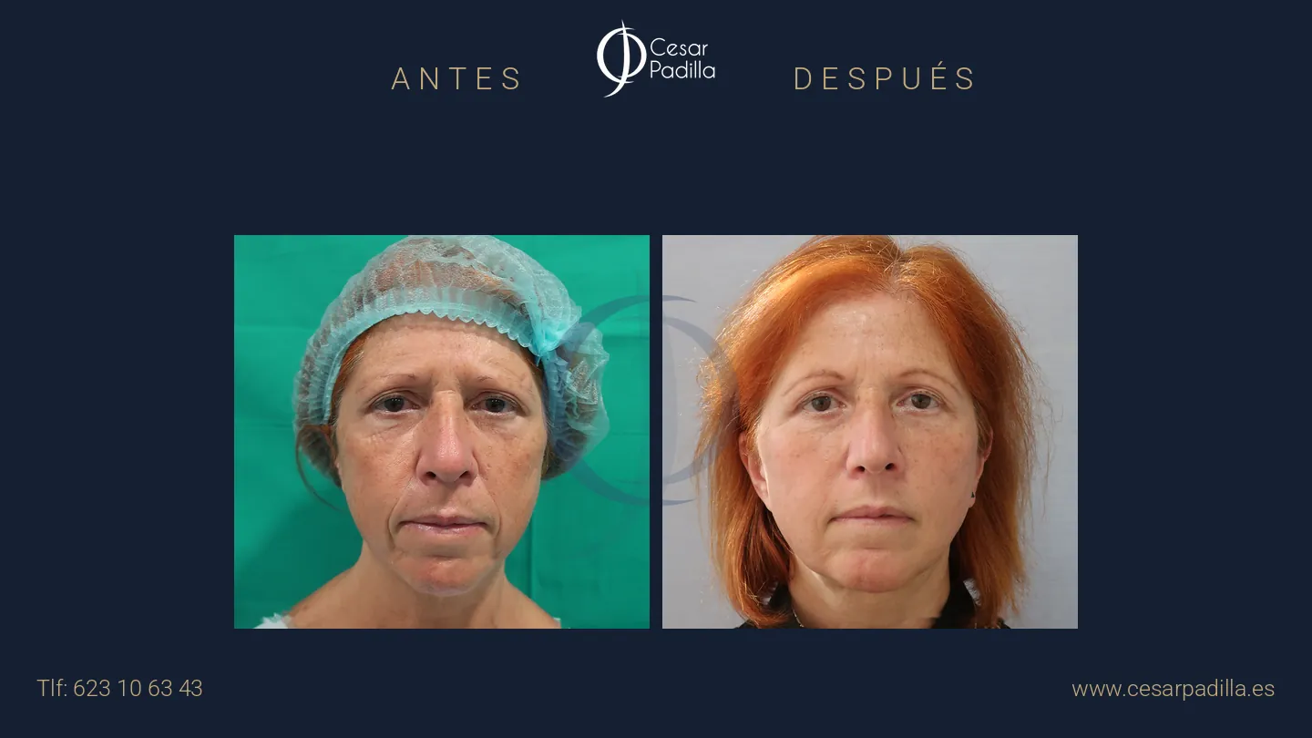Antes y después de Lifting facial