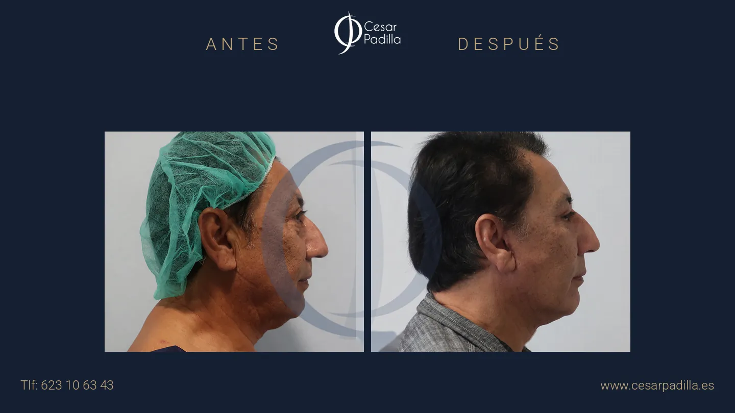 Antes y después de lifting facial, caso 10