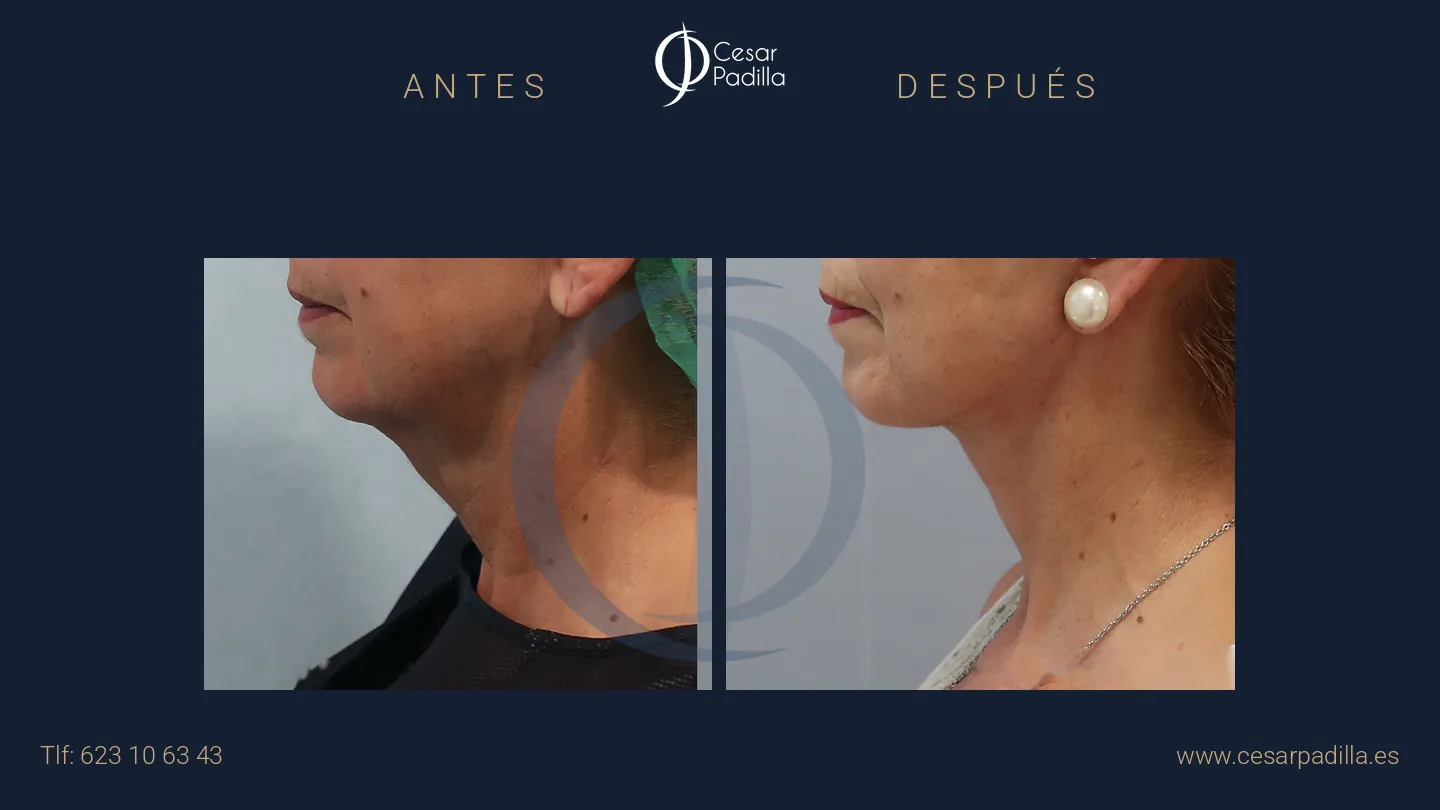 Antes y después de lifting facial, caso 11