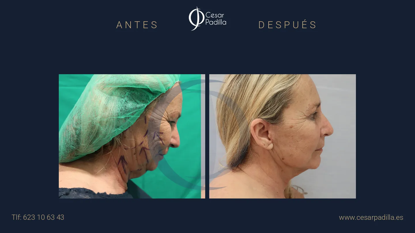 Antes y después de lifting facial, caso 12
