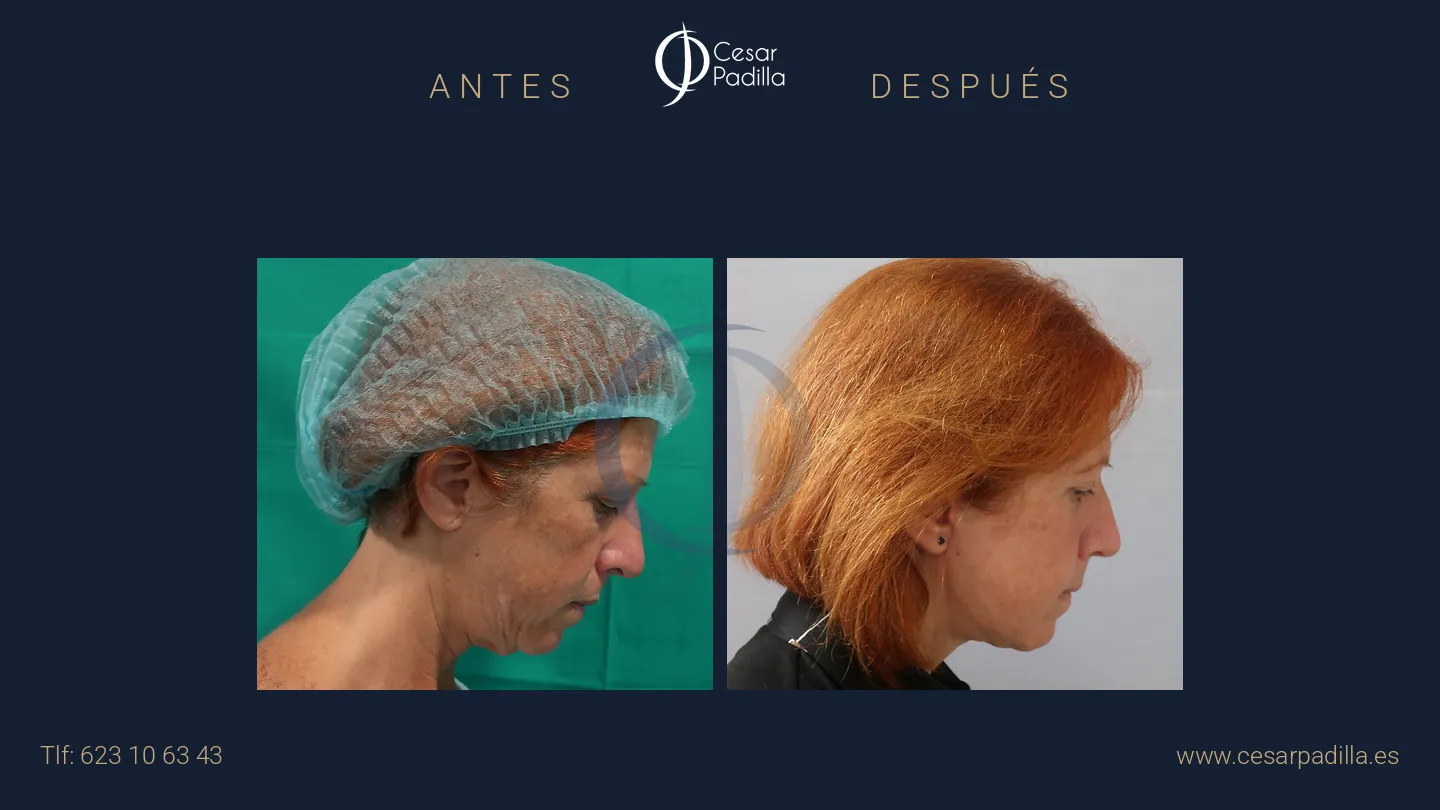 Antes y después de Lifting facial