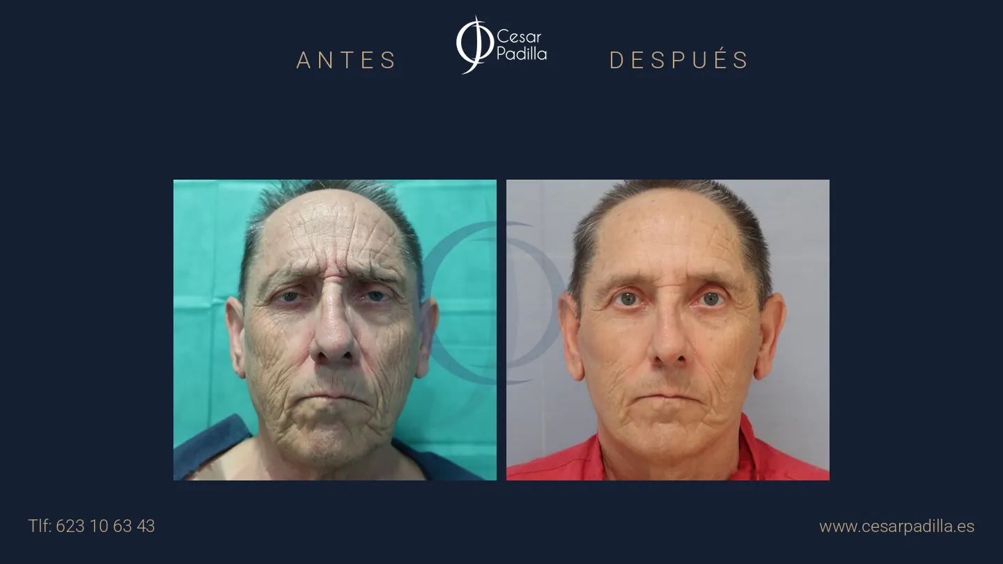 Antes y después de Lifting facial