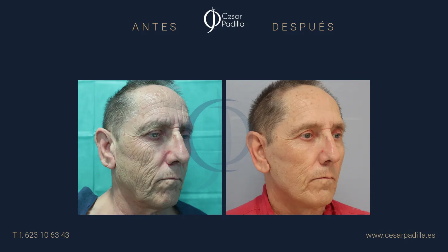Antes y después de Lifting facial