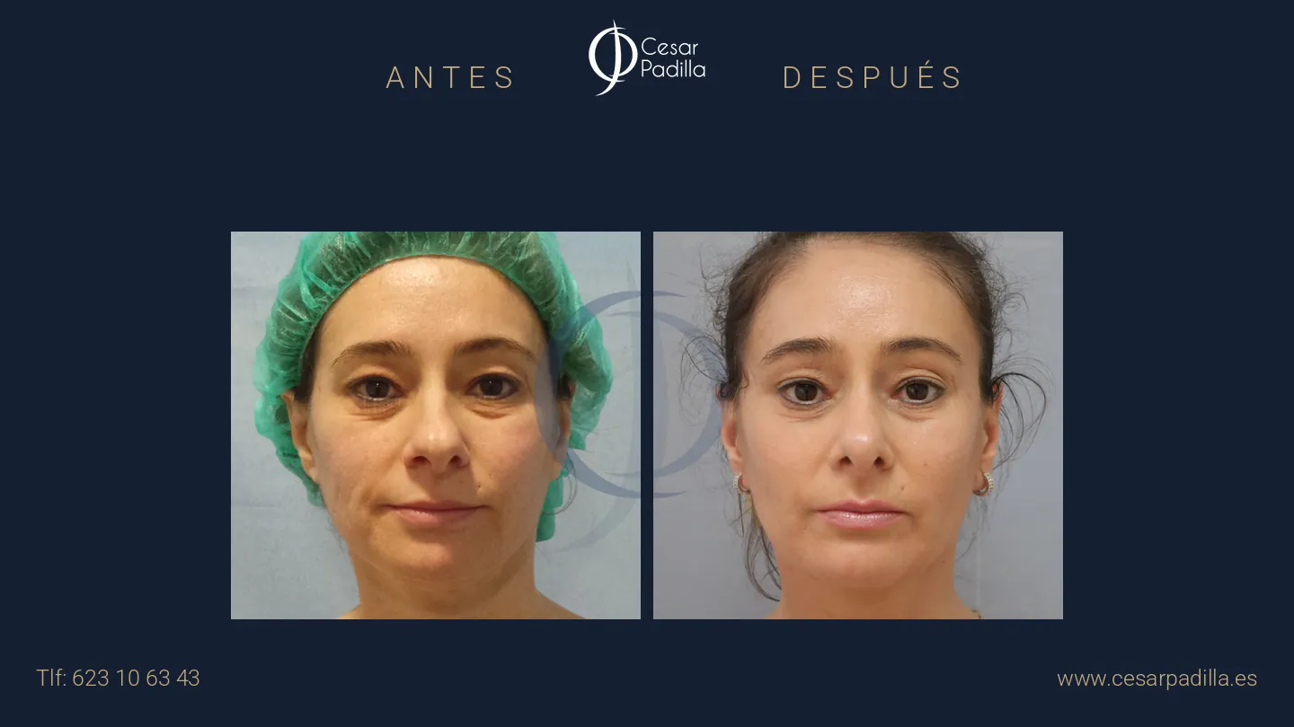 Antes y después de Lifting facial