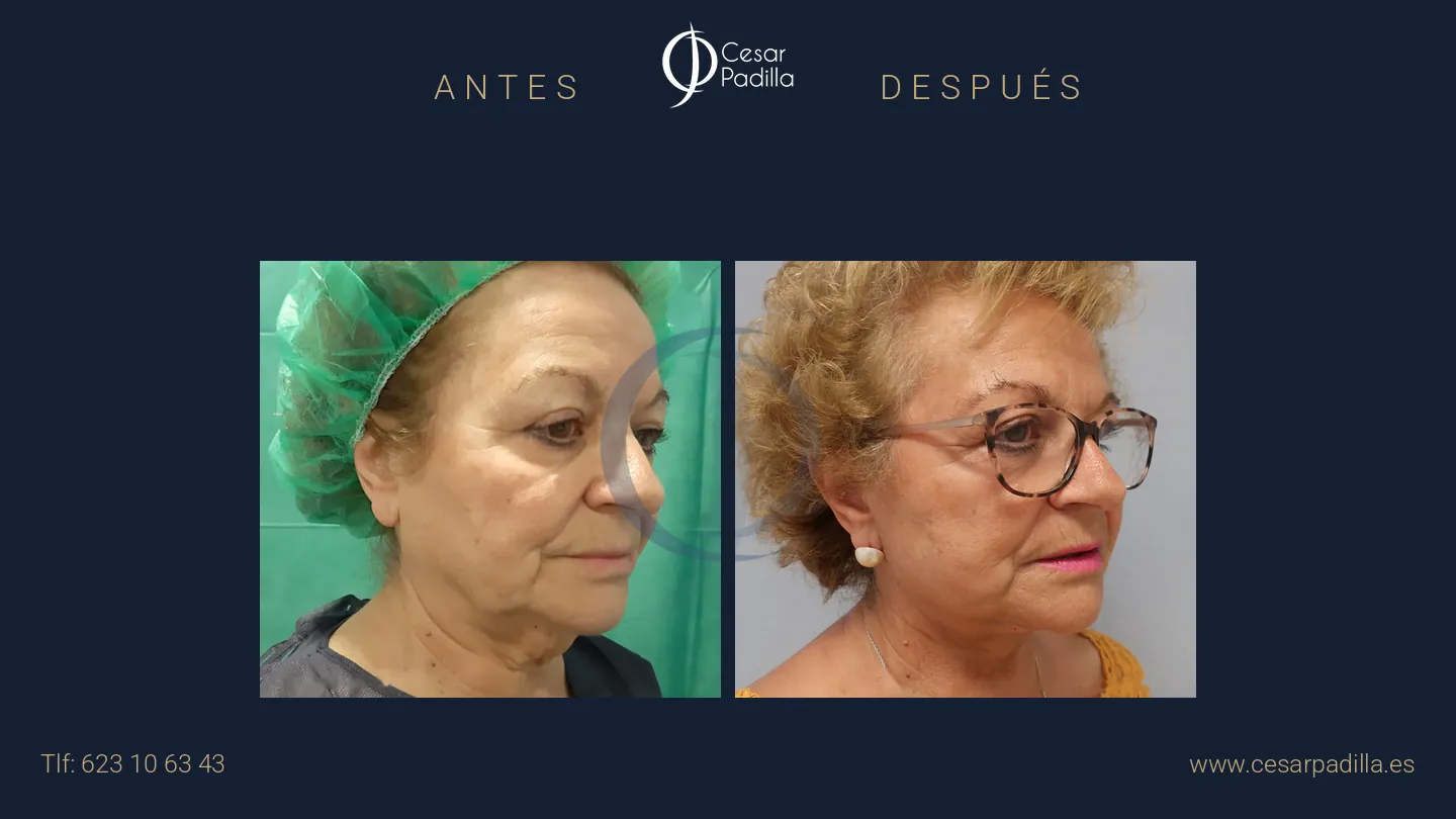 Antes y después de Lifting facial