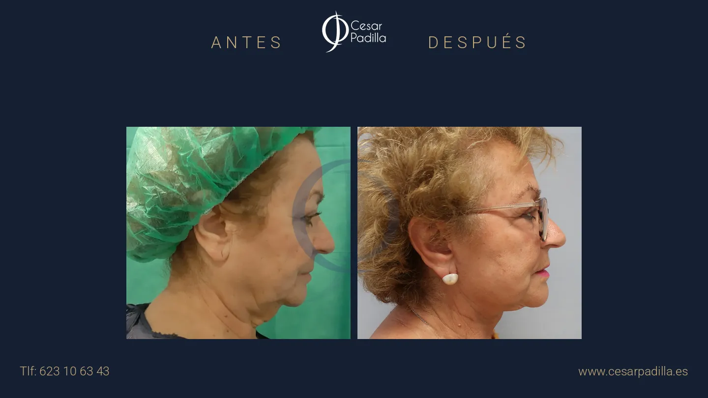 Antes y después de Lifting facial