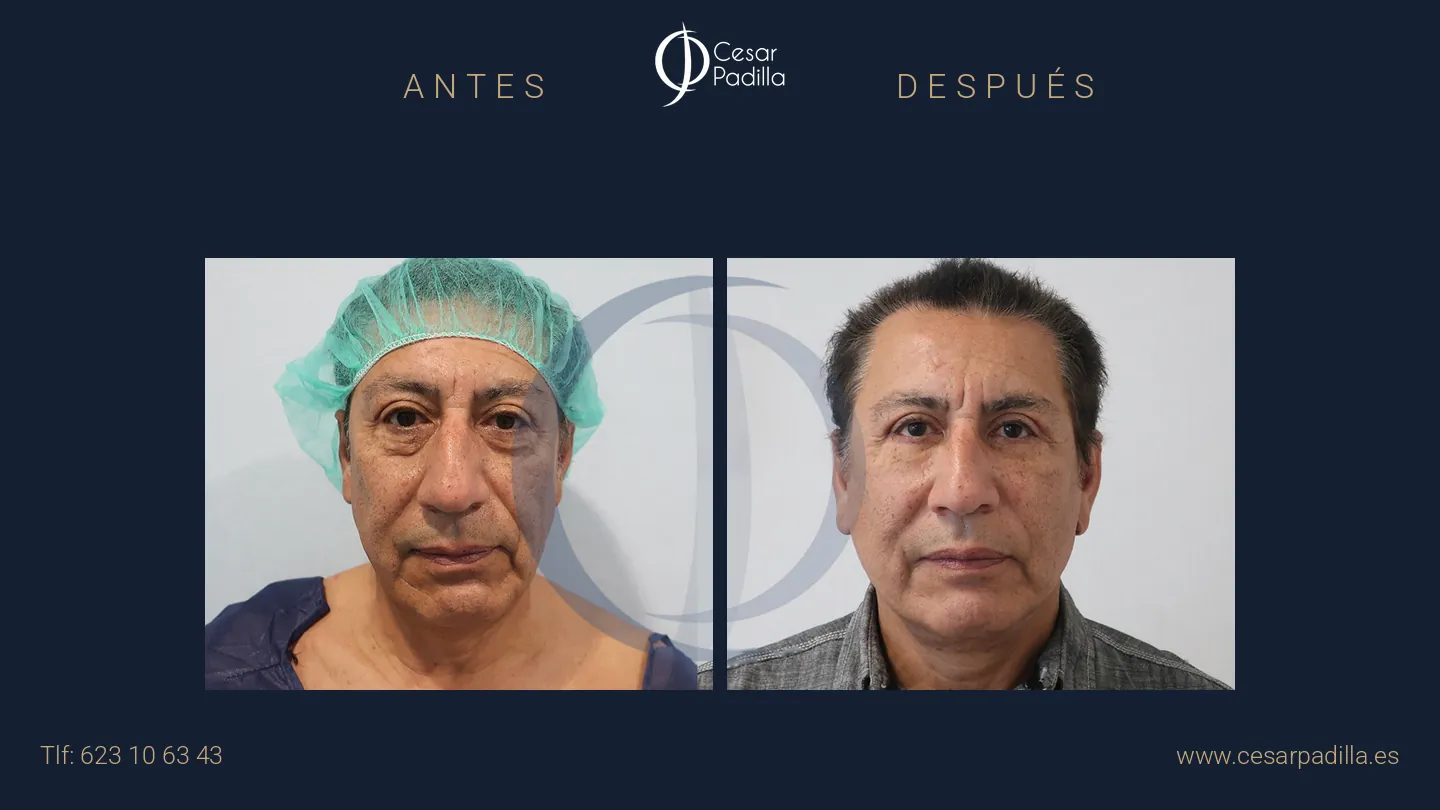 Antes y después de Lifting facial