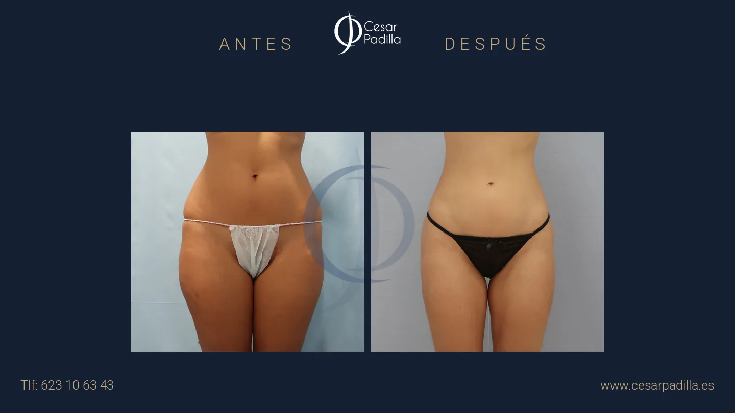 Antes y después de liposucción, caso 1