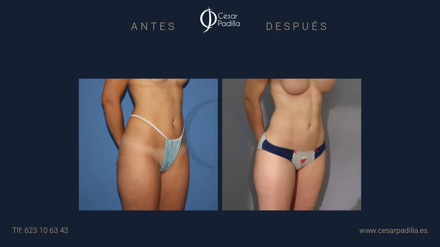 Antes y después de liposucción, caso 10