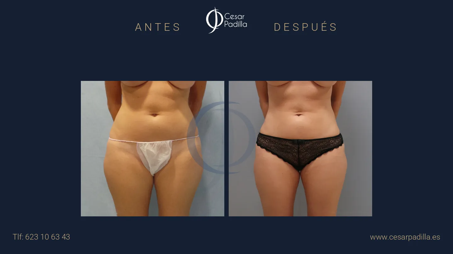 Antes y después de liposucción, caso 11