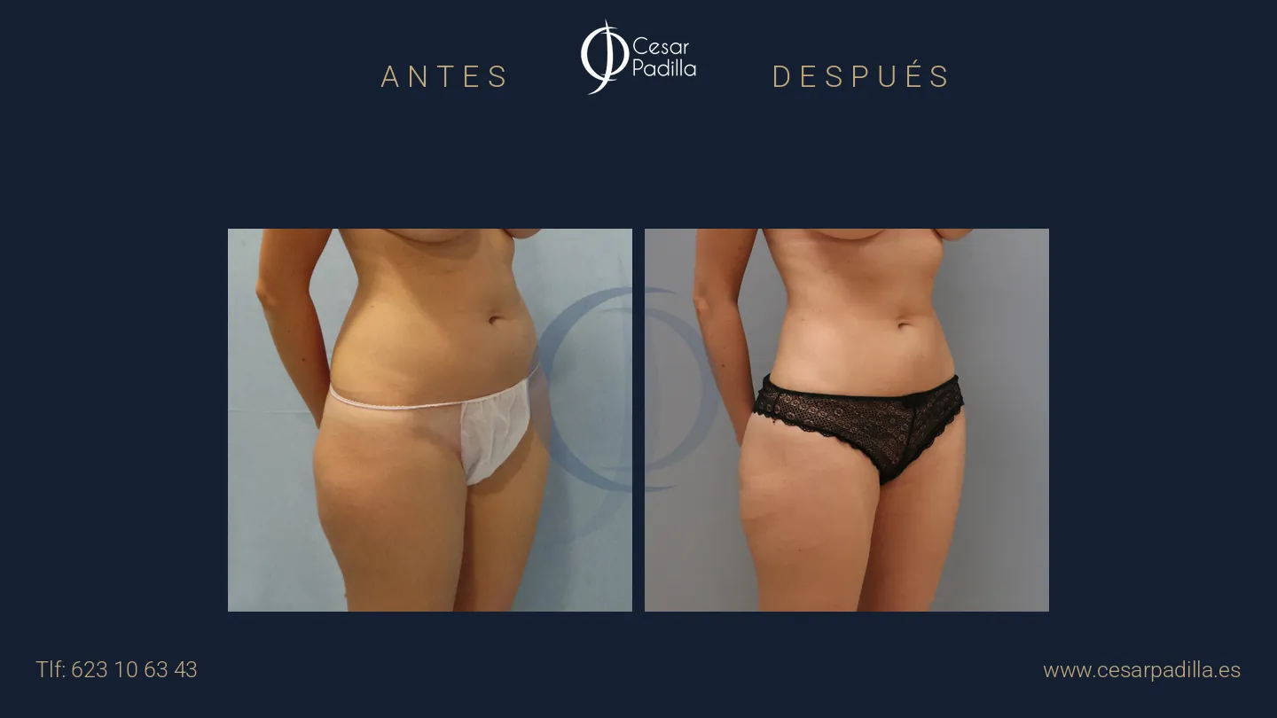 Antes y después de liposucción, caso 12