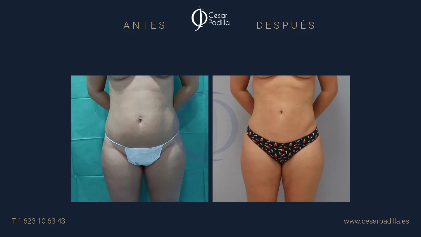 Antes y después de liposucción, caso 13
