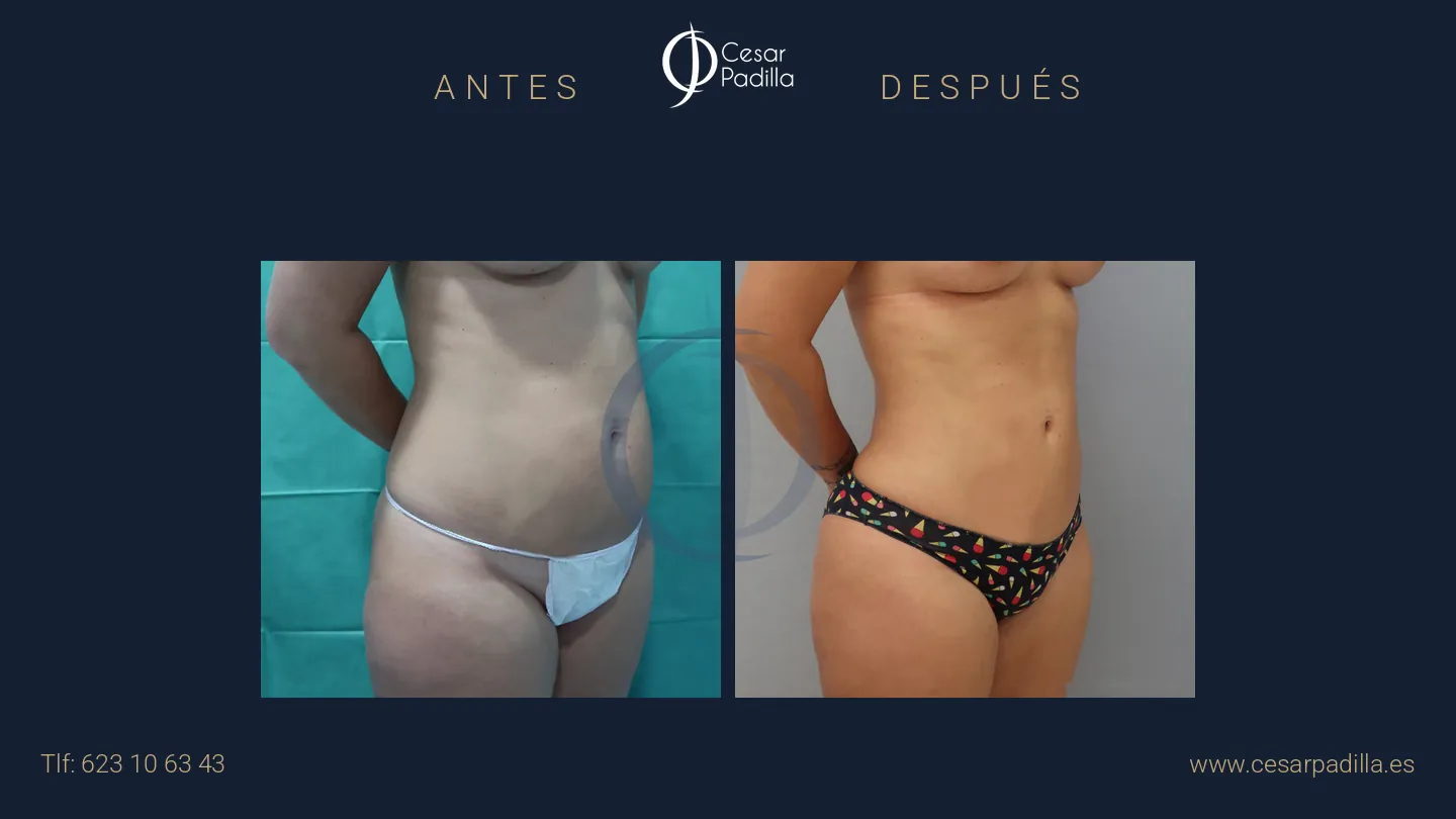 Antes y después de liposucción, caso 14