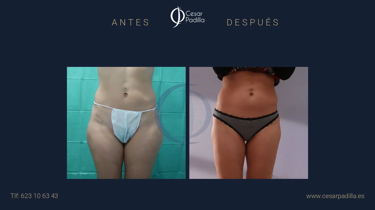 Antes y después de liposucción, caso 15