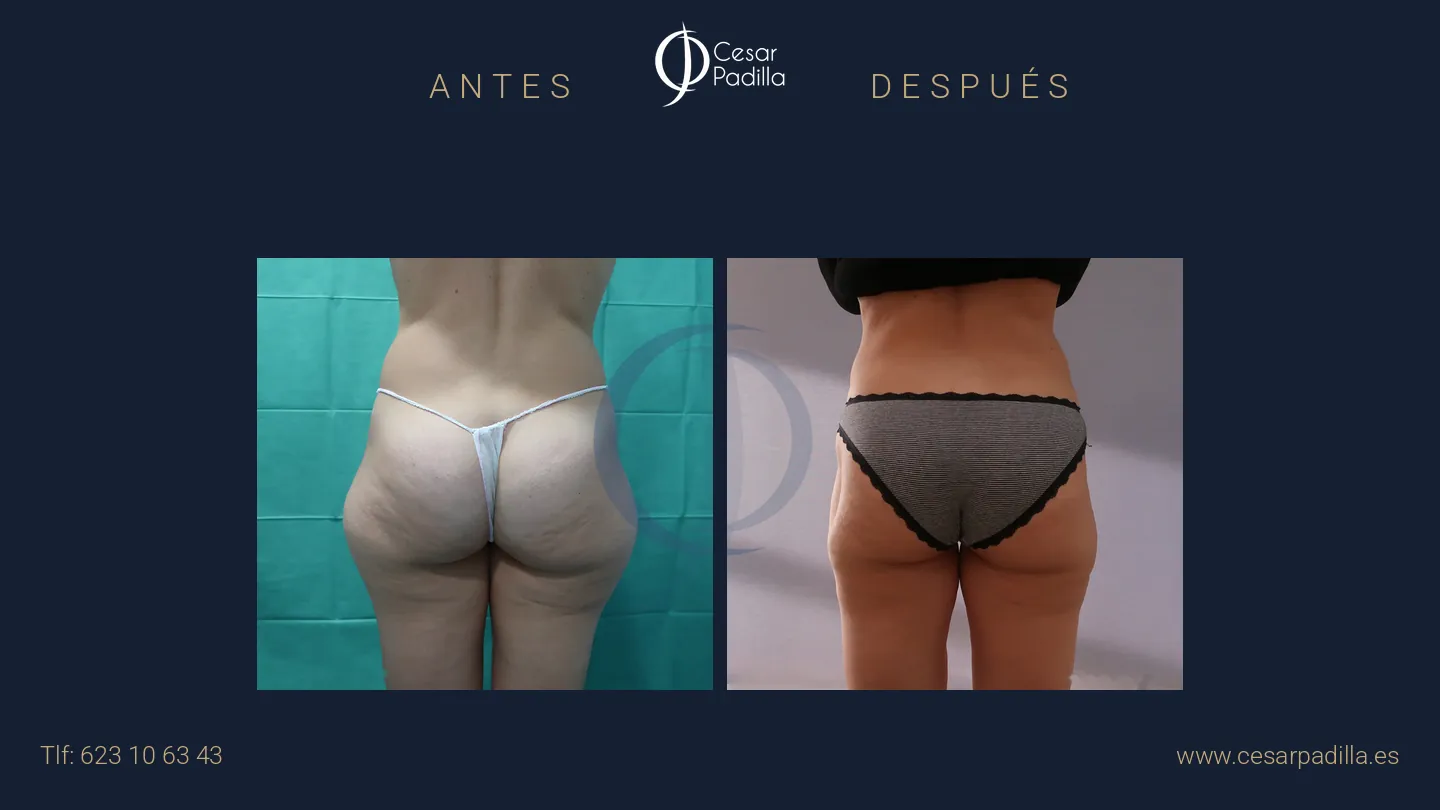 Antes y después de liposucción, caso 16