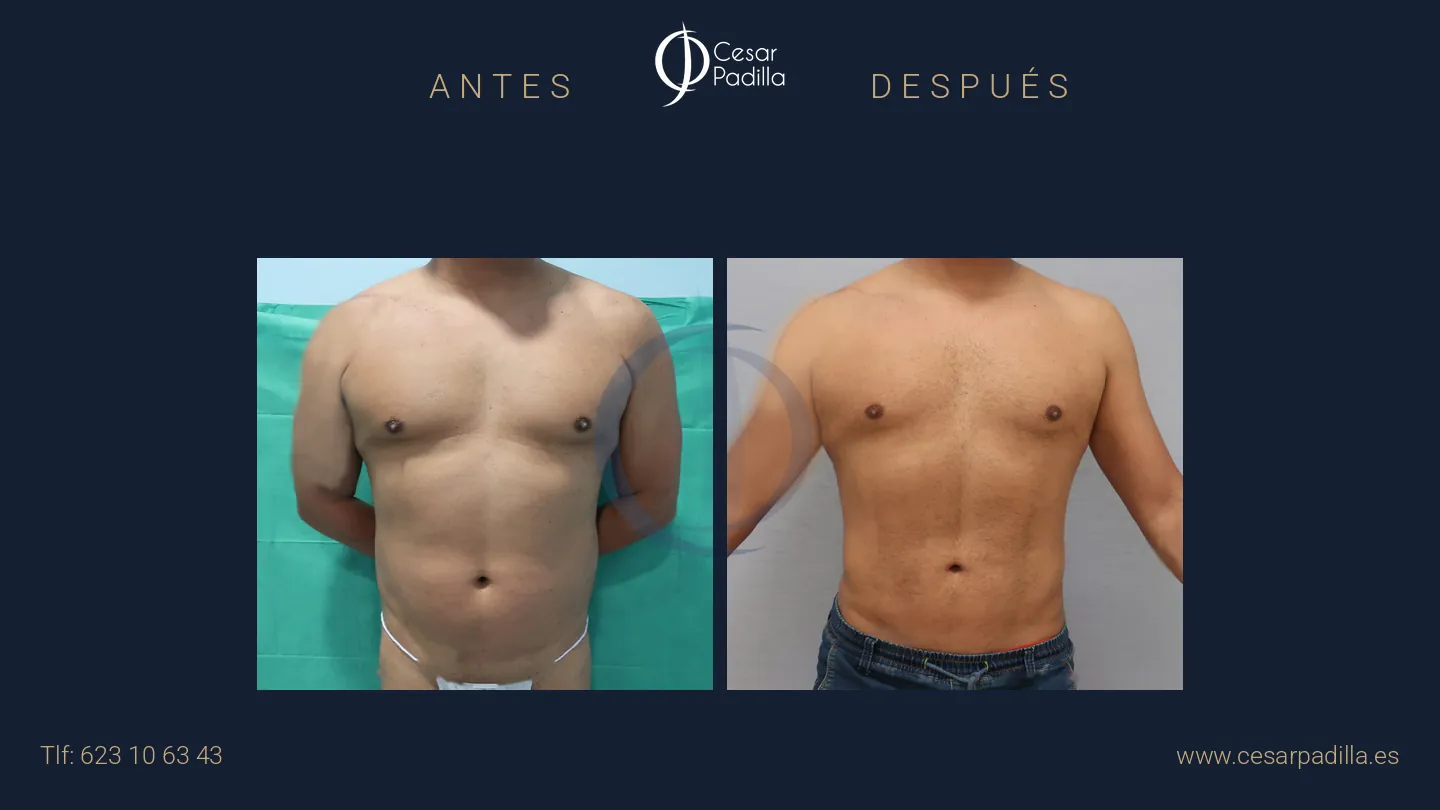 Antes y después de liposucción, caso 17