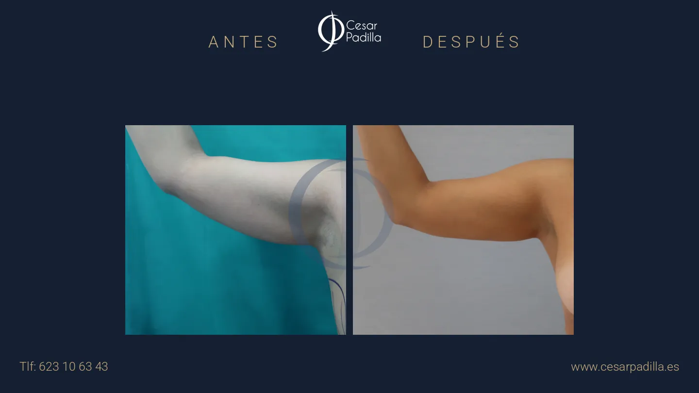 Antes y después de liposucción, caso 18