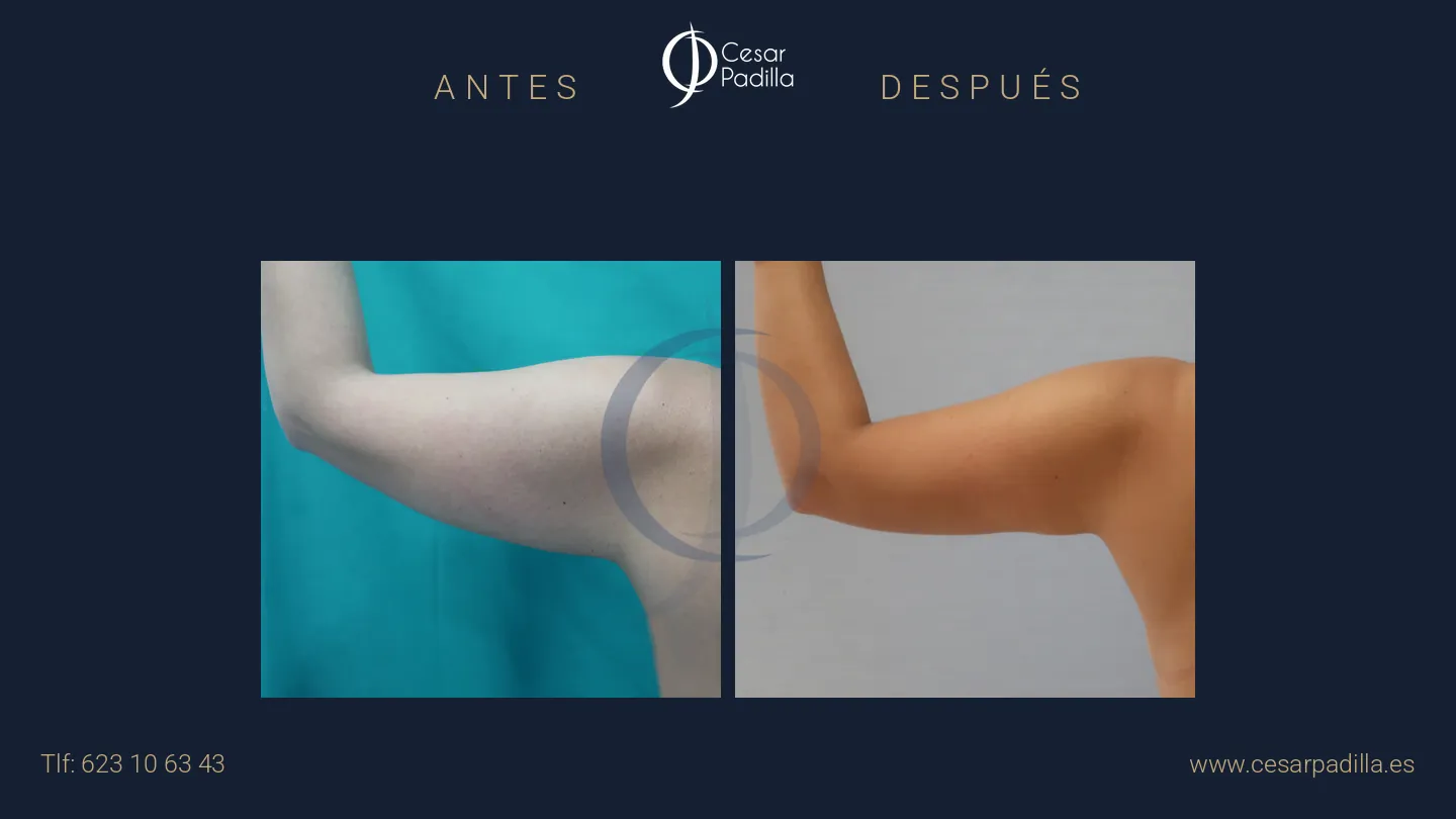 Antes y después de liposucción, caso 19