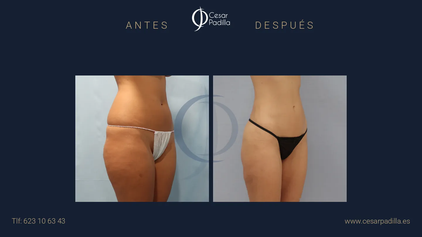 Antes y después de liposucción, caso 2