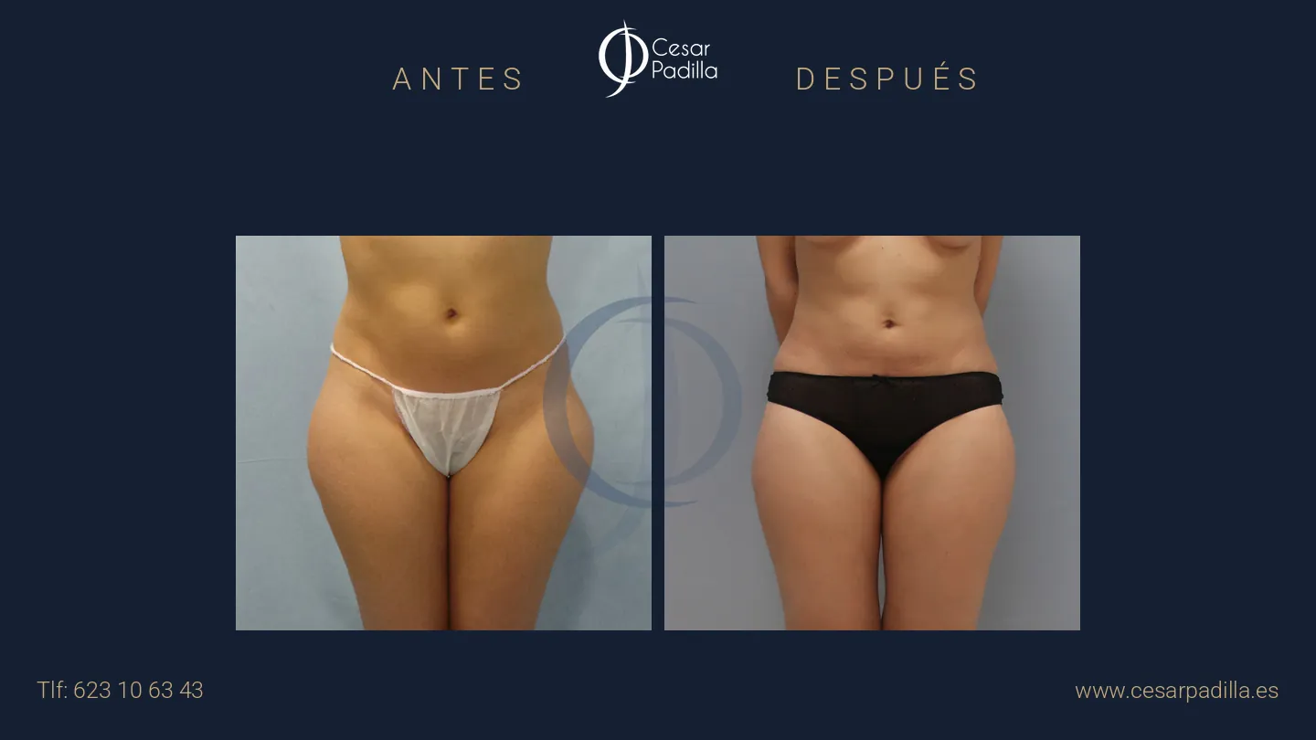 Antes y después de liposucción, caso 20