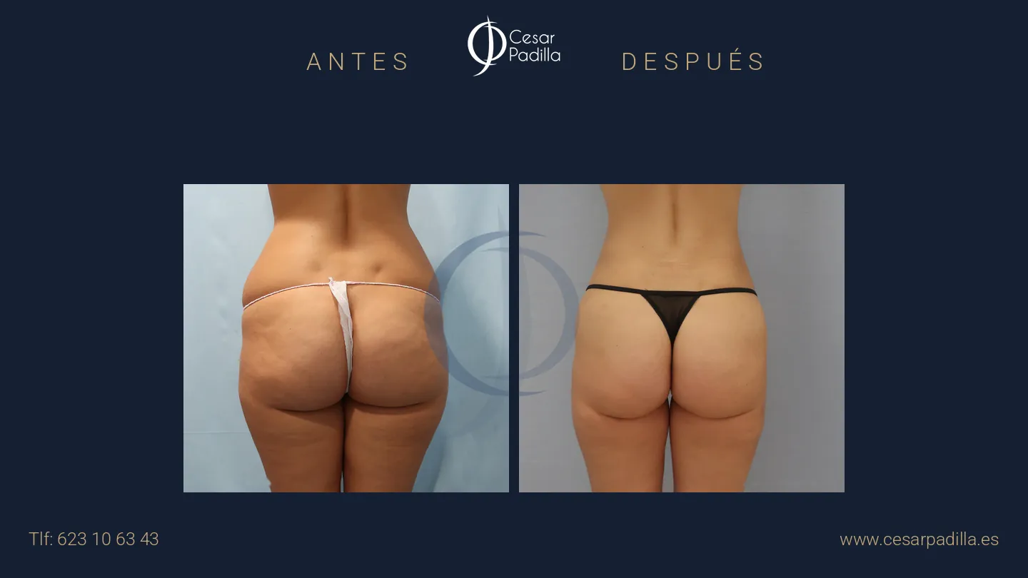 Antes y después de liposucción, caso 3