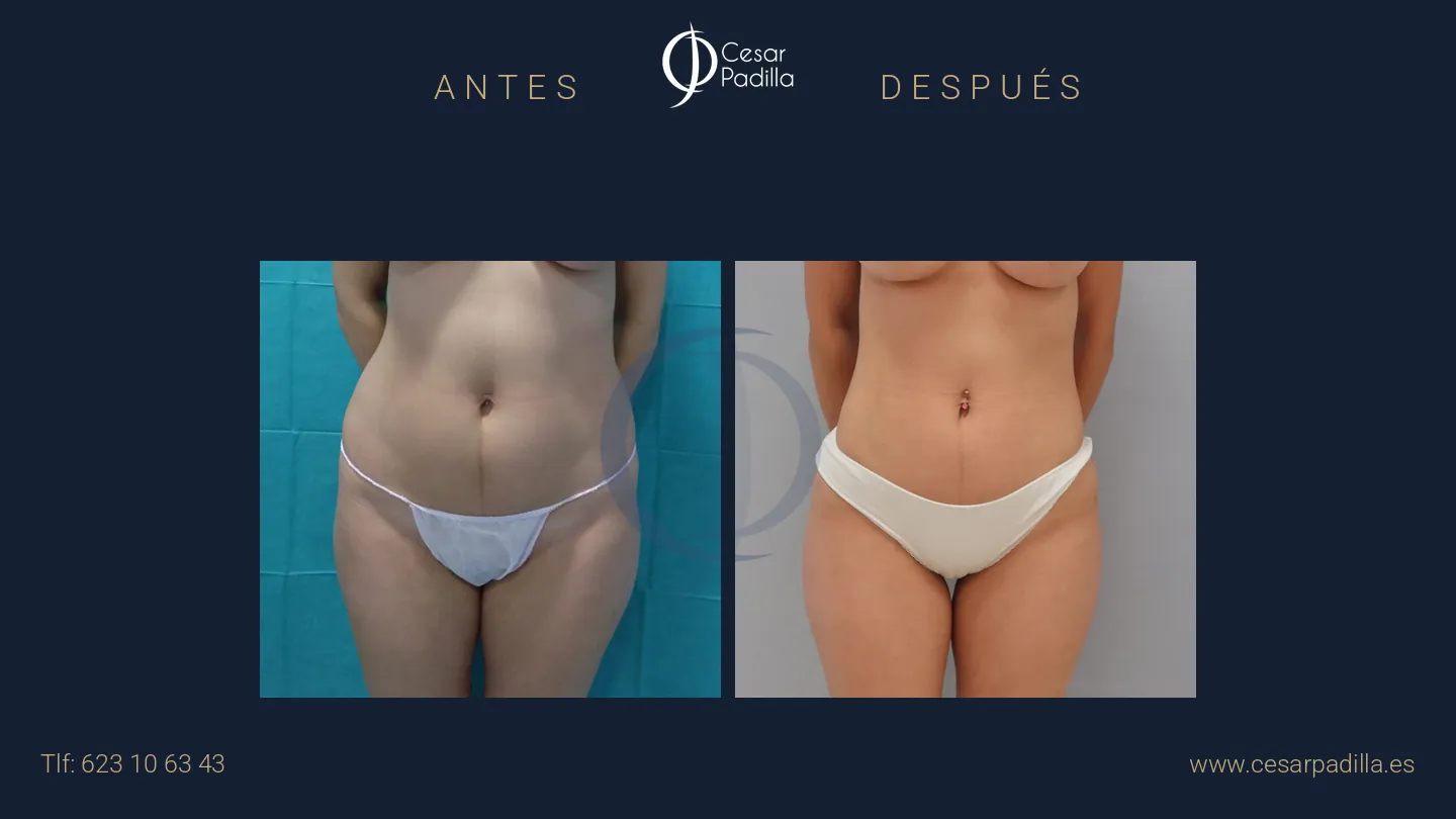 Antes y después de liposucción, caso 4