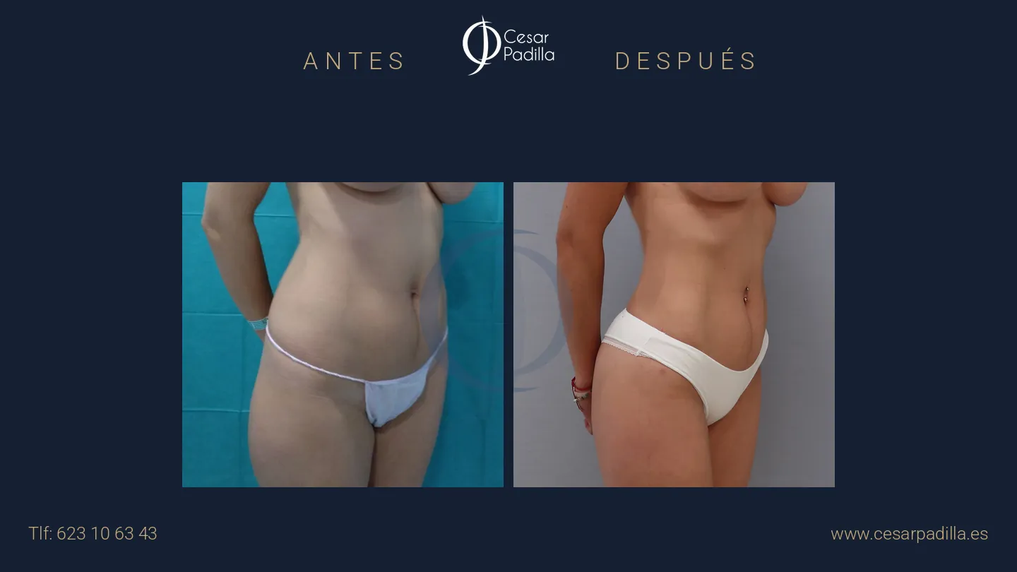 Antes y después de liposucción, caso 5