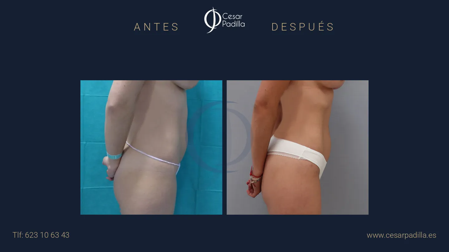 Antes y después de liposucción, caso 6