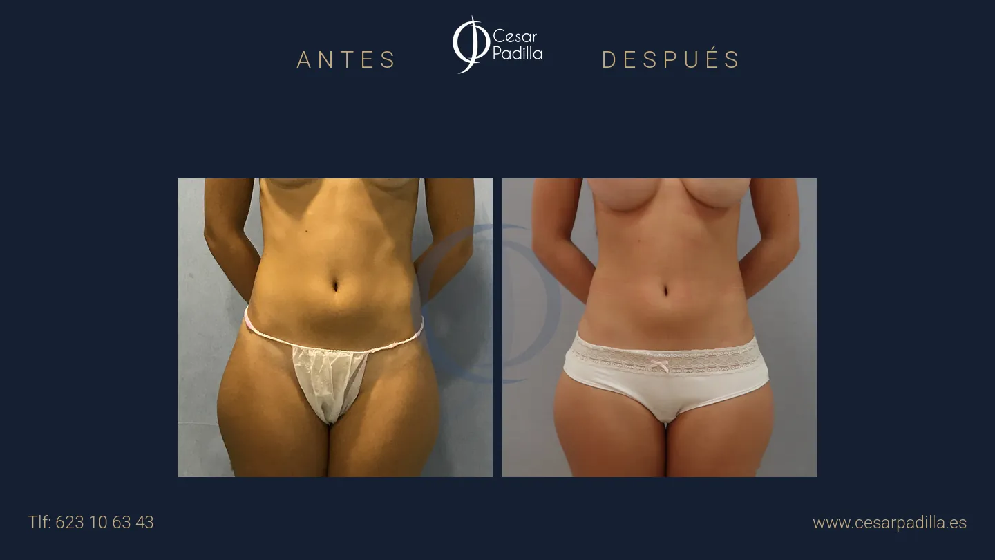 Antes y después de liposucción, caso 7