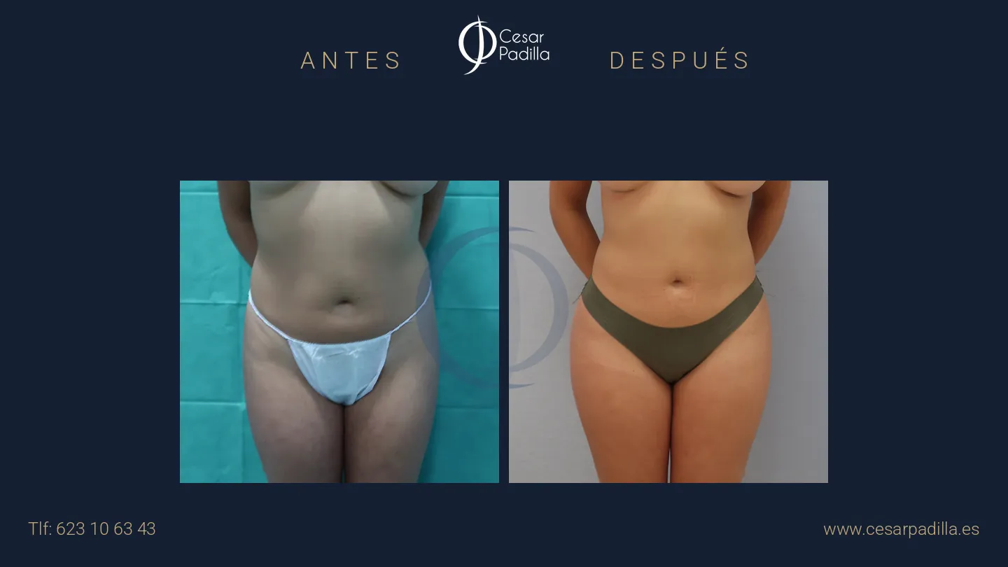 Antes y después de liposucción, caso 8