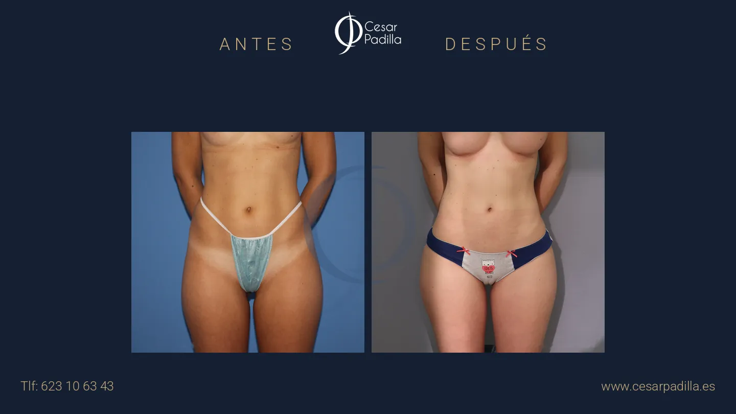 Antes y después de liposucción, caso 9