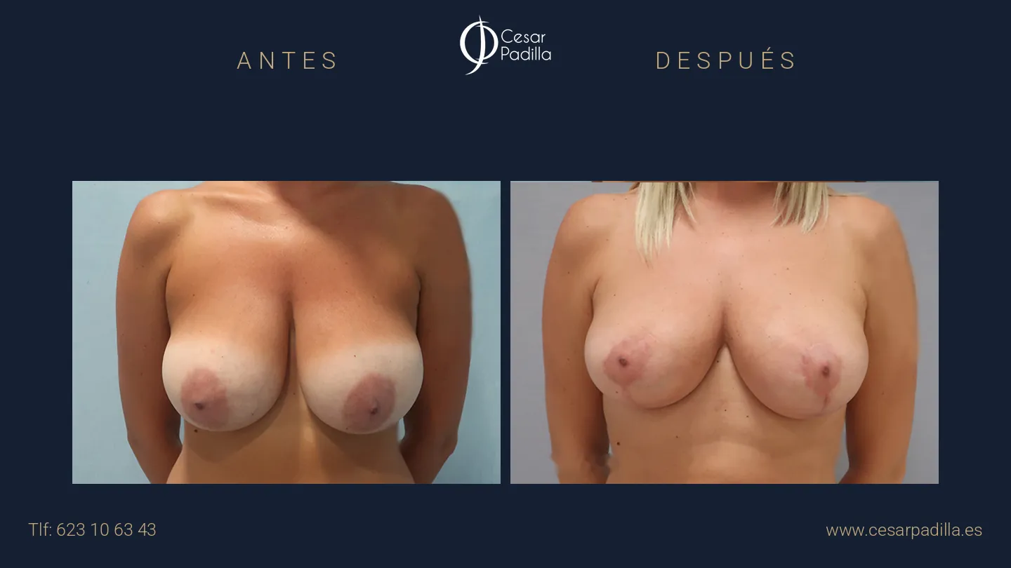 Antes y después de mastopexia lollipop, caso 11