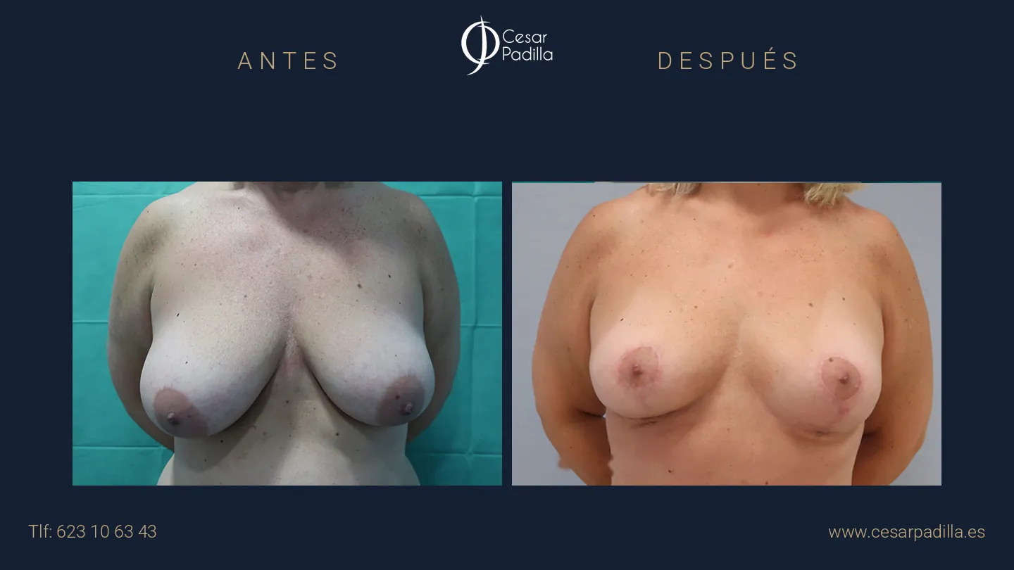 Antes y después de mastopexia lollipop, caso 12