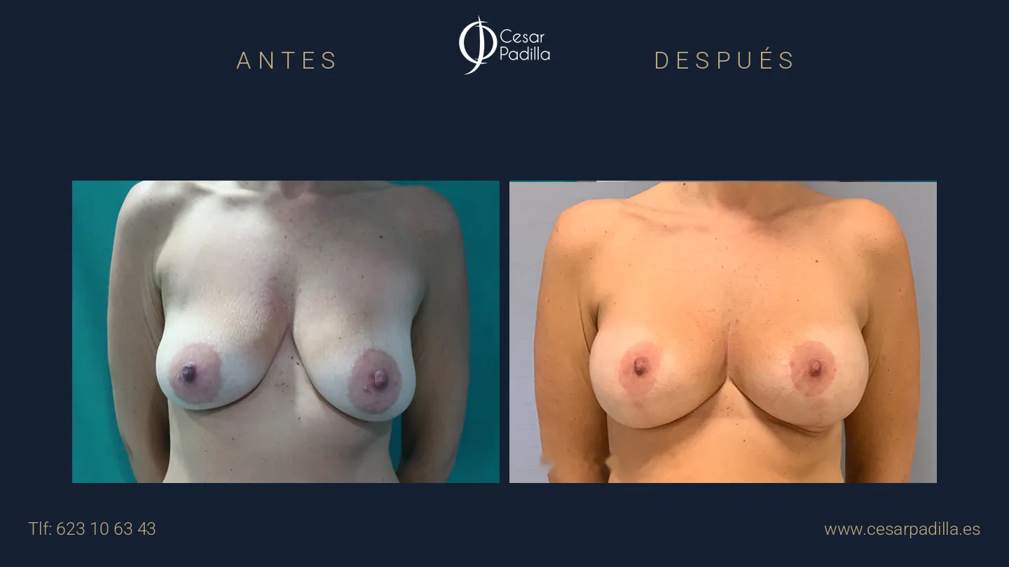 Antes y después de mastopexia lollipop, caso 16