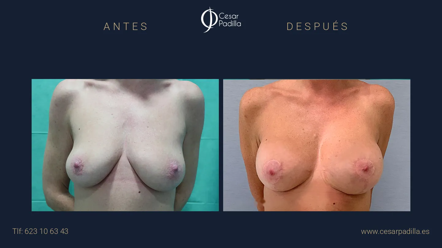 Antes y después de mastopexia lollipop, caso 17
