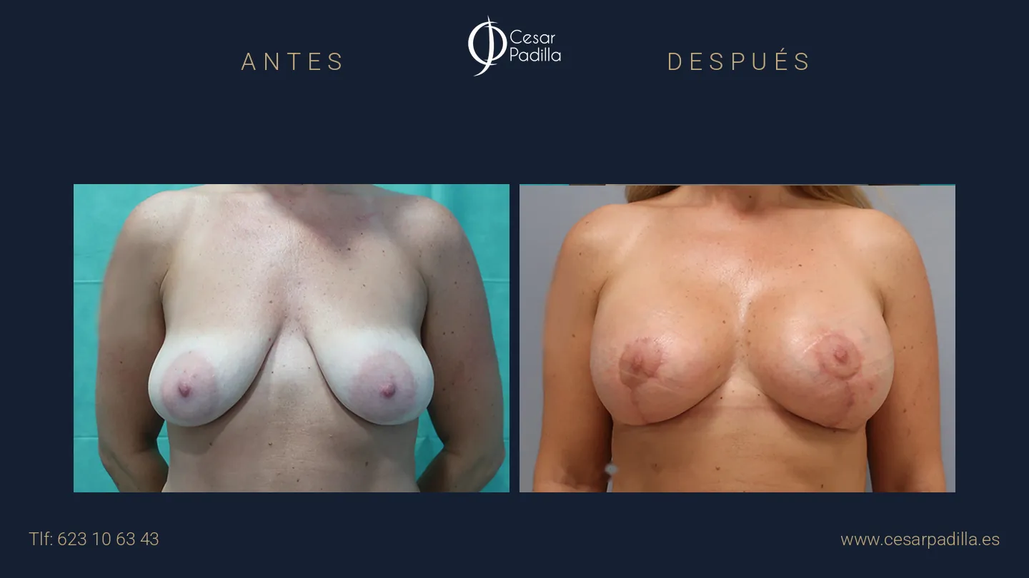 Antes y después de mastopexia lollipop, caso 19