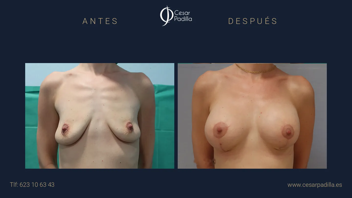 Antes y después de mastopexia lollipop, caso 20