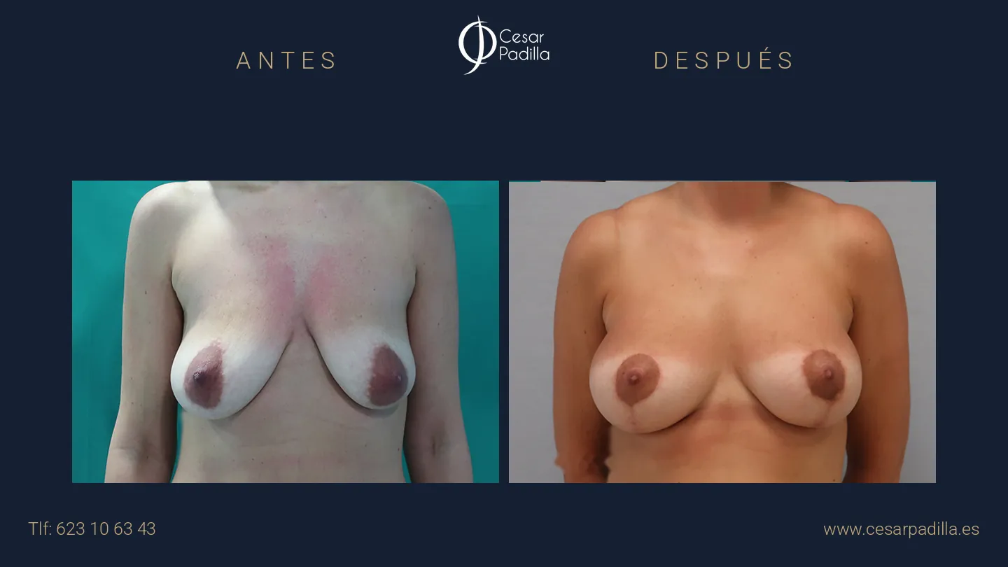 Mastopexia con aumento en Málaga | Dr. César Padilla
