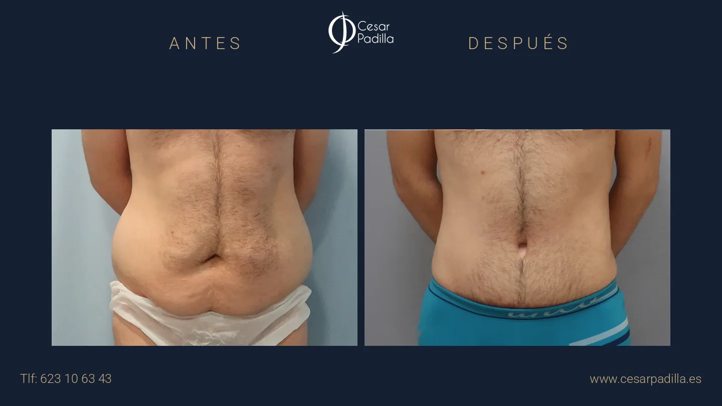 Antes y después de Abdominoplastia masculina