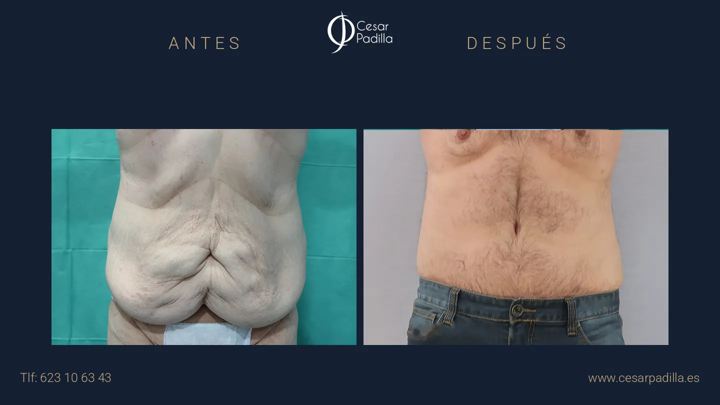 Antes y después de Abdominoplastia masculina